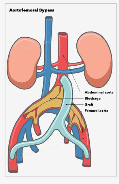 Peripheral Vascular Surgery
