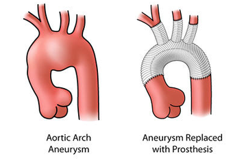 Aneurysms surgery