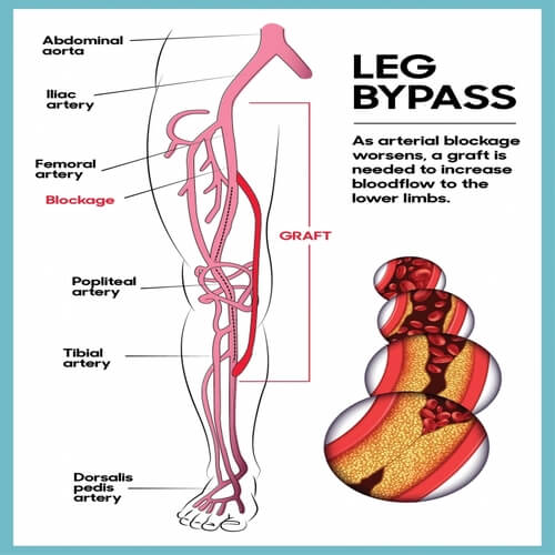 leg vessel block bypass surgery