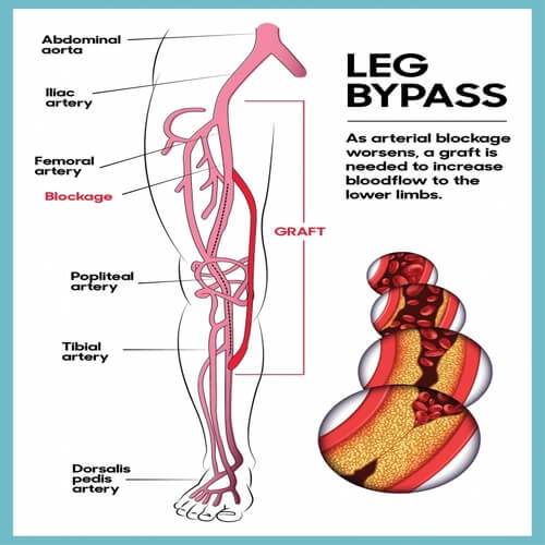 Leg Vessel Block Bypass Surgery