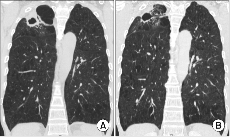 Lung Surgery