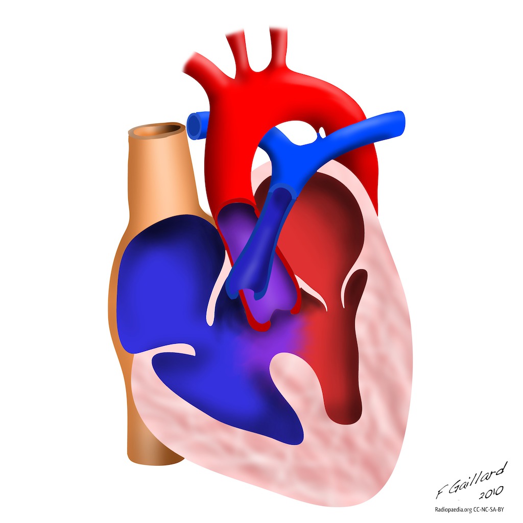 Children Open Heart Surgery