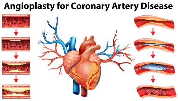 Coronary angiogram 