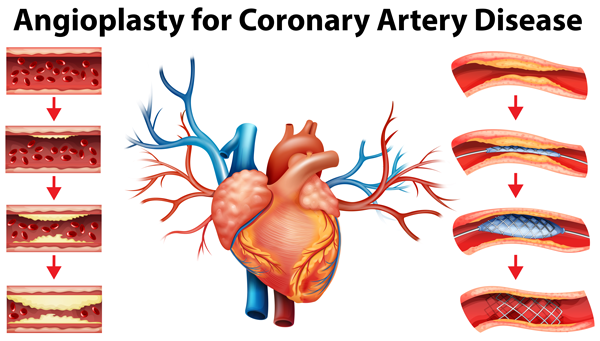 Coronary Angiogram 
