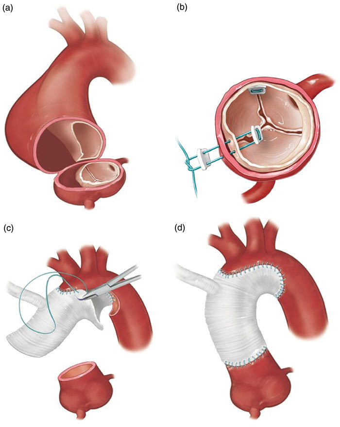 Aortic aneurysm surgery