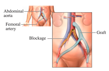 Aorto-Bi-femoral bypass surgery