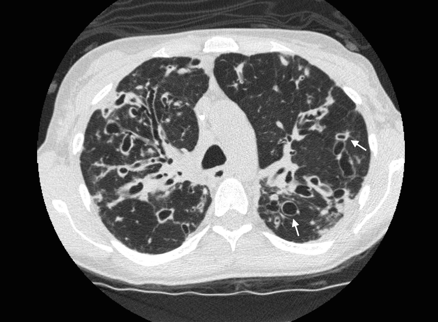 Lung Bronchiectasis Surgery