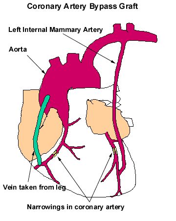 Adult Open Heart Surgery