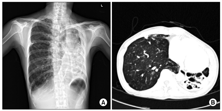 TB Destroyed Lung Surgery