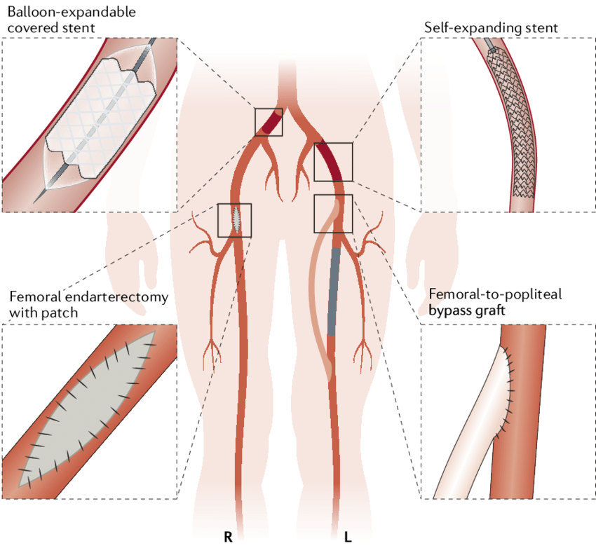 Endovascular Surgery