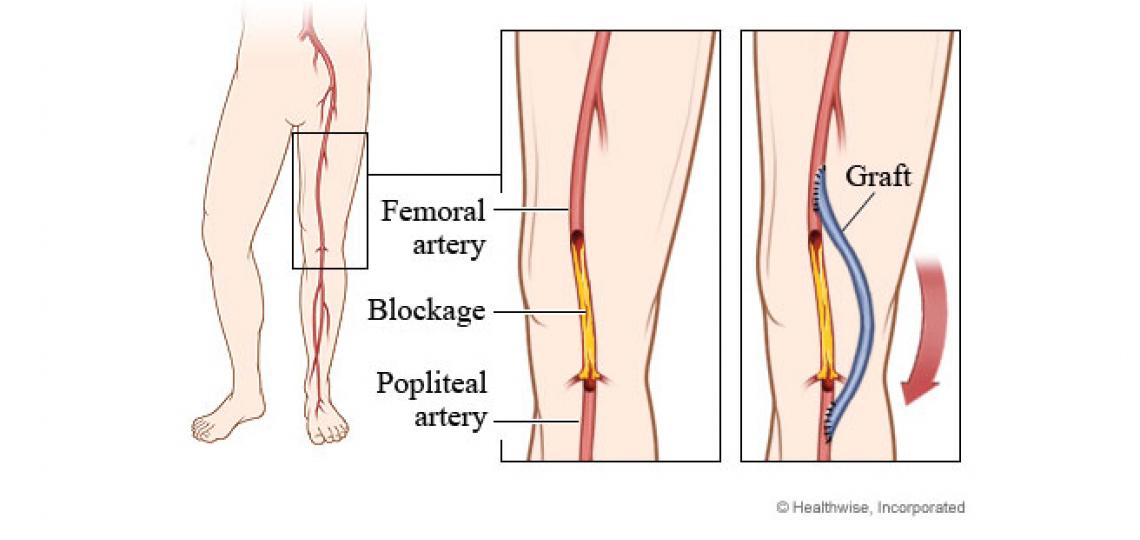 Femoral bypass surgery