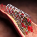 Stent Implantation