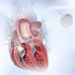 AICD Implantation