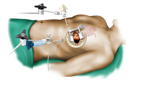 Keyhole Heart Surgery