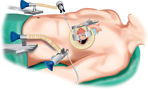 Key Hole Heart Surgery