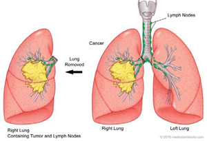Lung Cancer Surgery
