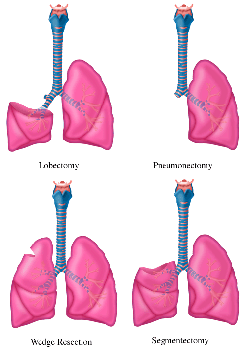 Lungs surgeries