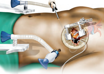 Adult Heart Surgery
