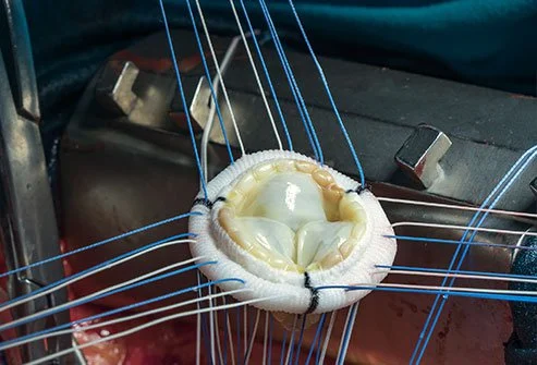Valve Replacement