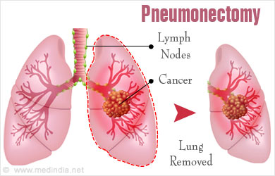 Pneumonectomy