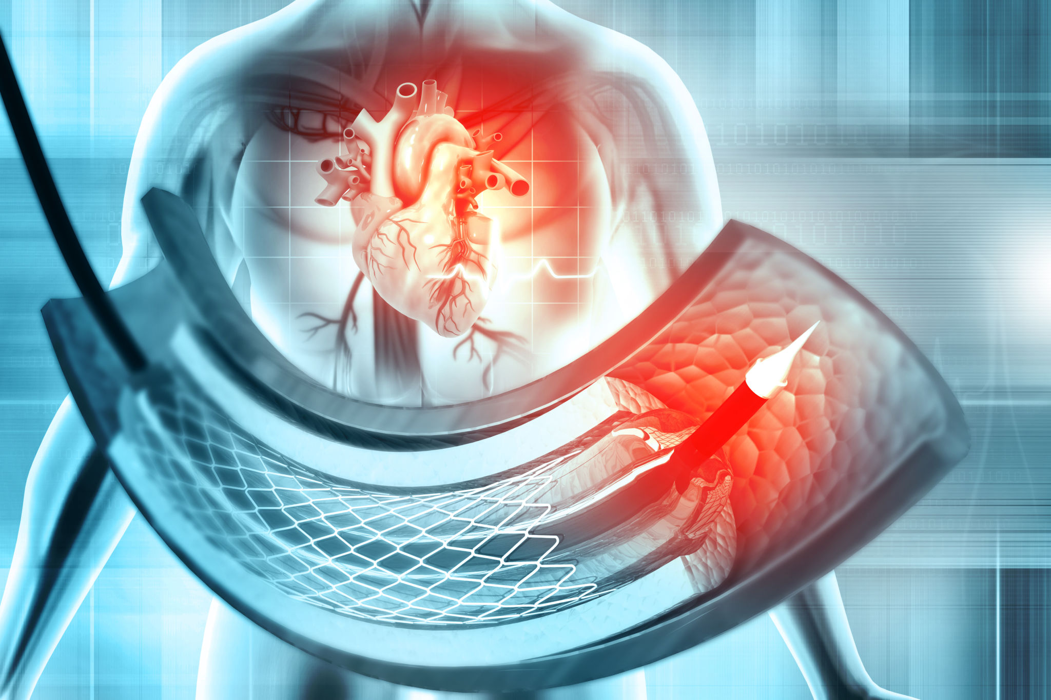 Coronary Angiography 