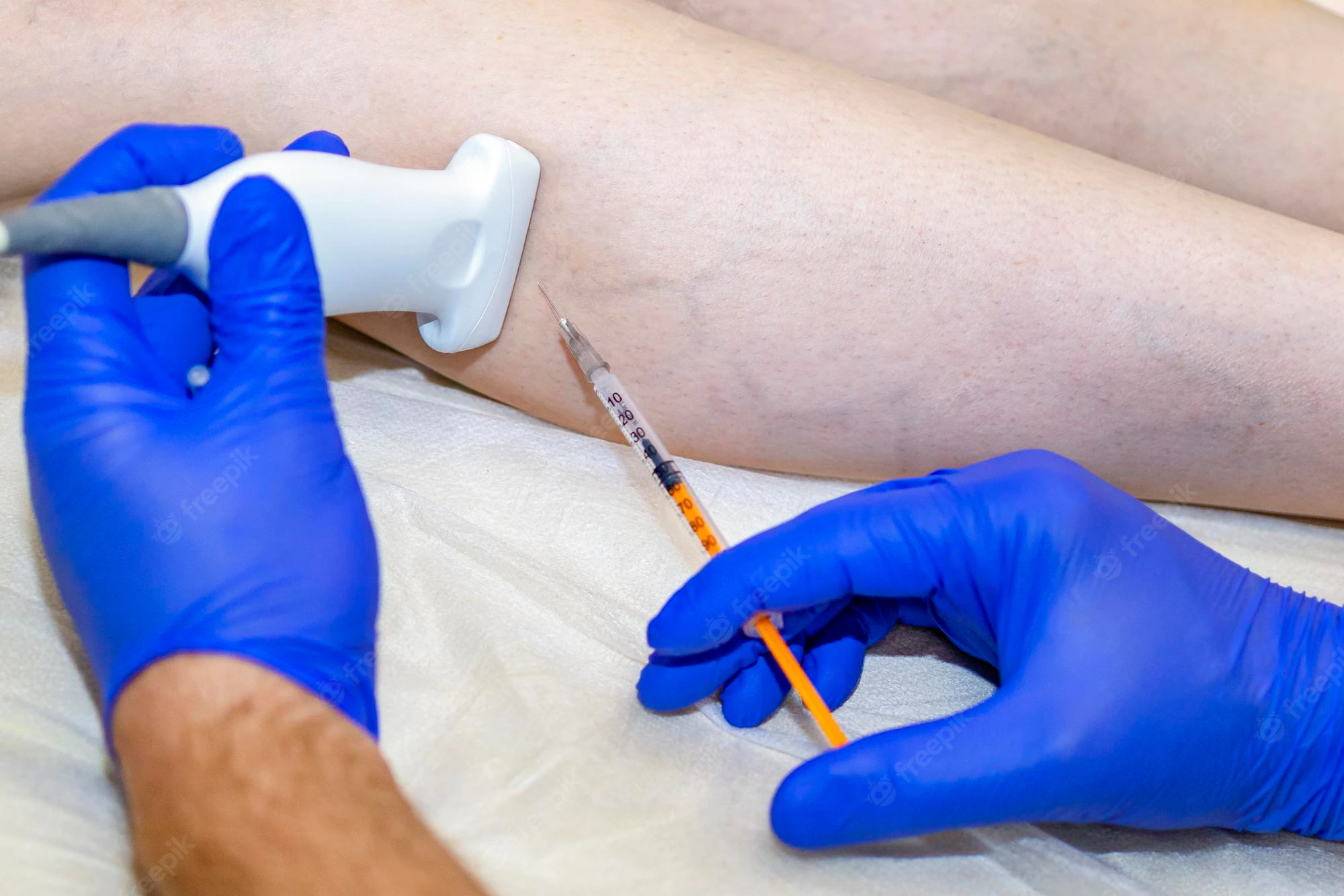 Varicose vein sclerotherapy