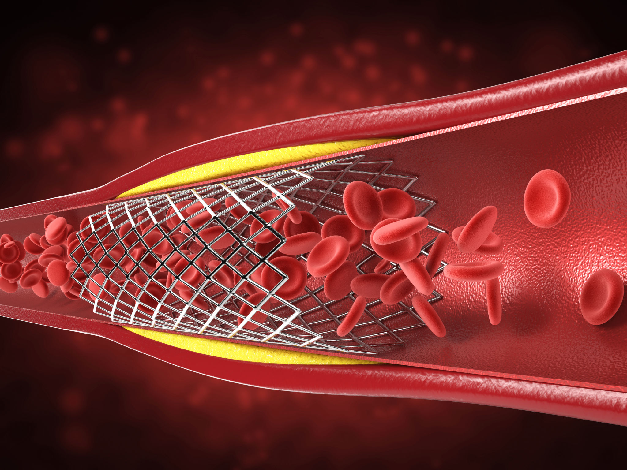 Angioplasty & Stenting 
