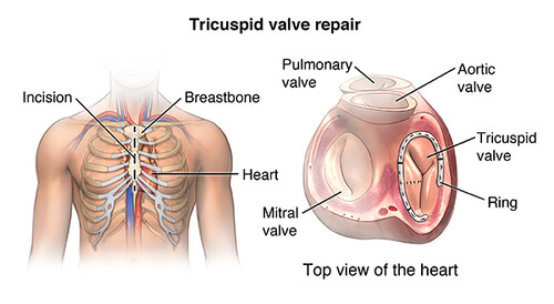 Tricuspide valve repair