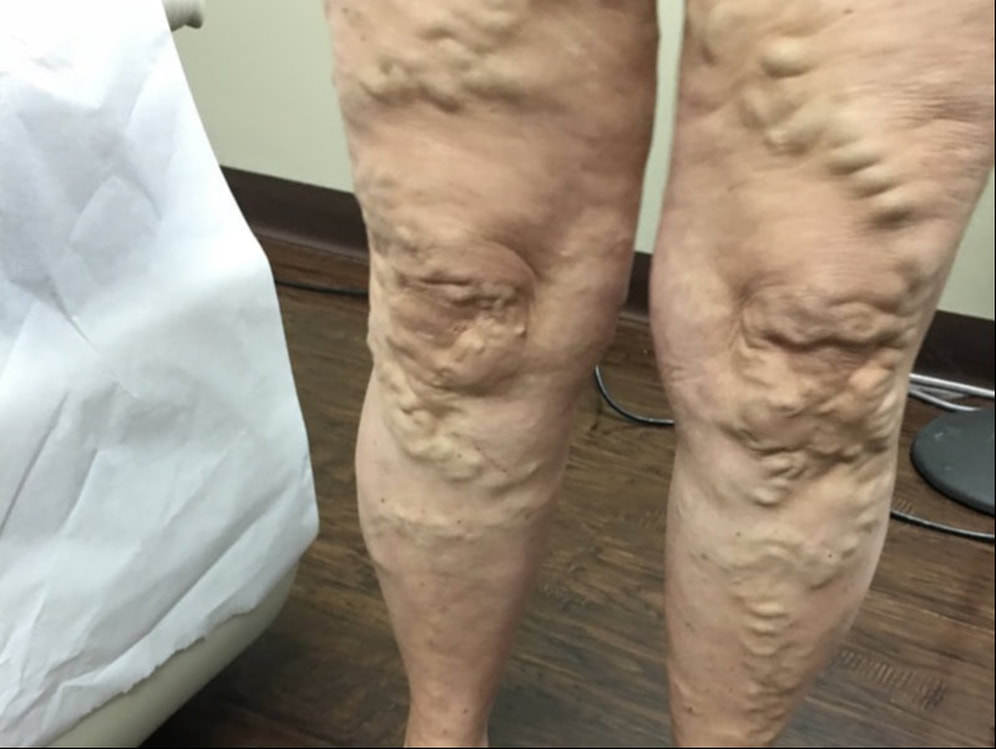 Surgery for Vein Diseases