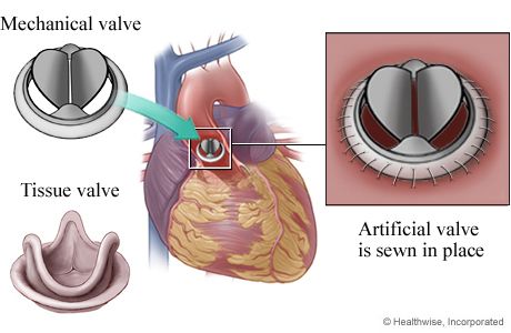 Heart Valve Surgery