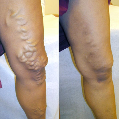 Varicose Vein Surgery